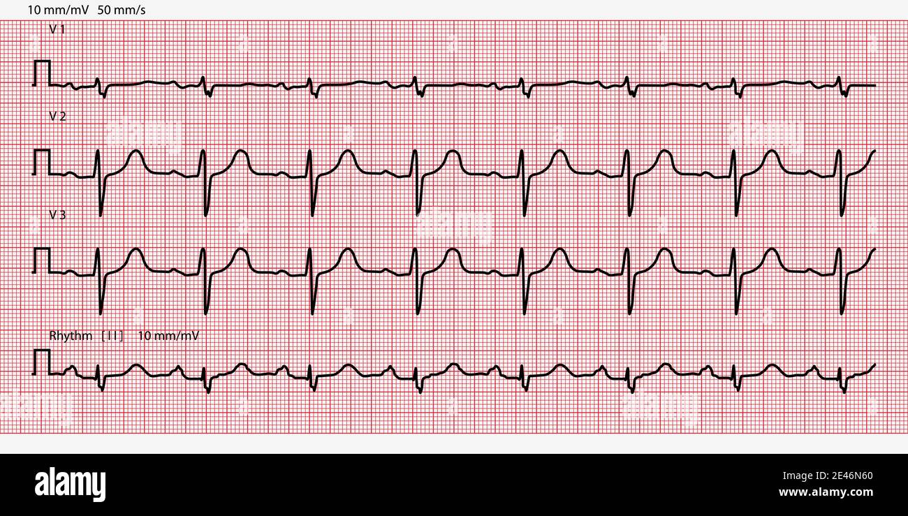 Carta per elettrocardiogramma, carta millimetrica. Illustrazione vettoriale Illustrazione Vettoriale