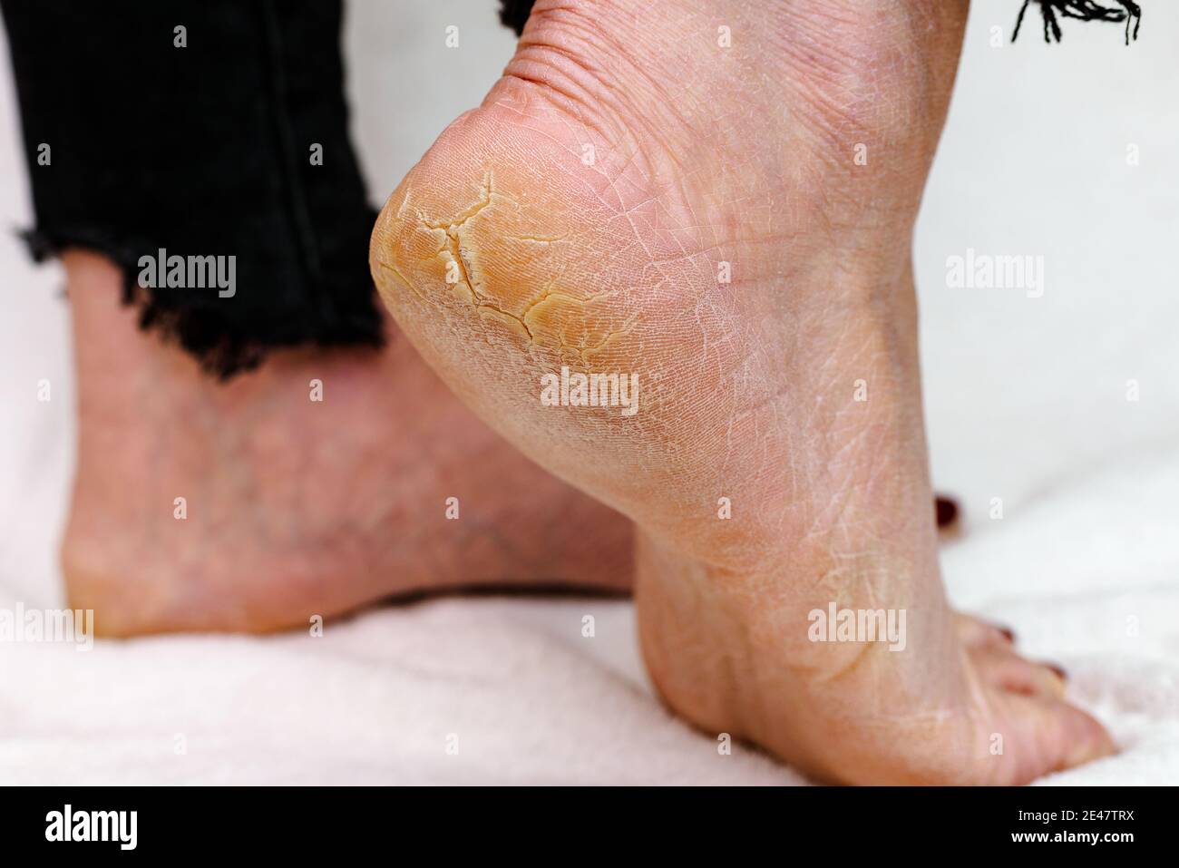 Suole di piedi asciutte e fessurate. Piedi Womans con tacchi asciutti, cracked skin.White sfondo morbido. Foto Stock