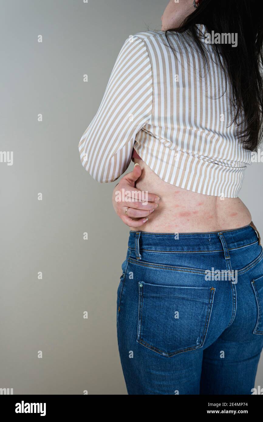 Donne con sintomi di orticaria pruriginosa o reazione allergica sulla pelle.  Eruzione cutanea rossa sul corpo femminile. Concetti di allergia, malattie  della pelle e salute c Foto stock - Alamy