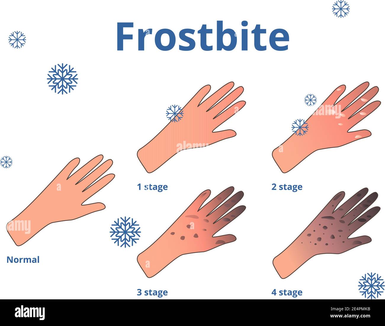 Tavole frostbite, cartoni animati vettoriali illustrazione delle mani Illustrazione Vettoriale