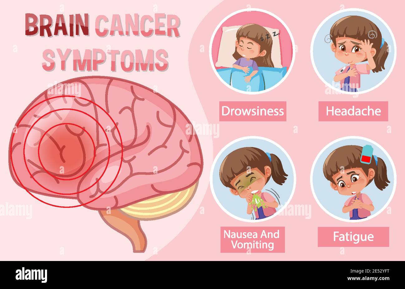 Informazioni mediche sull'illustrazione dei sintomi del cancro al cervello Illustrazione Vettoriale