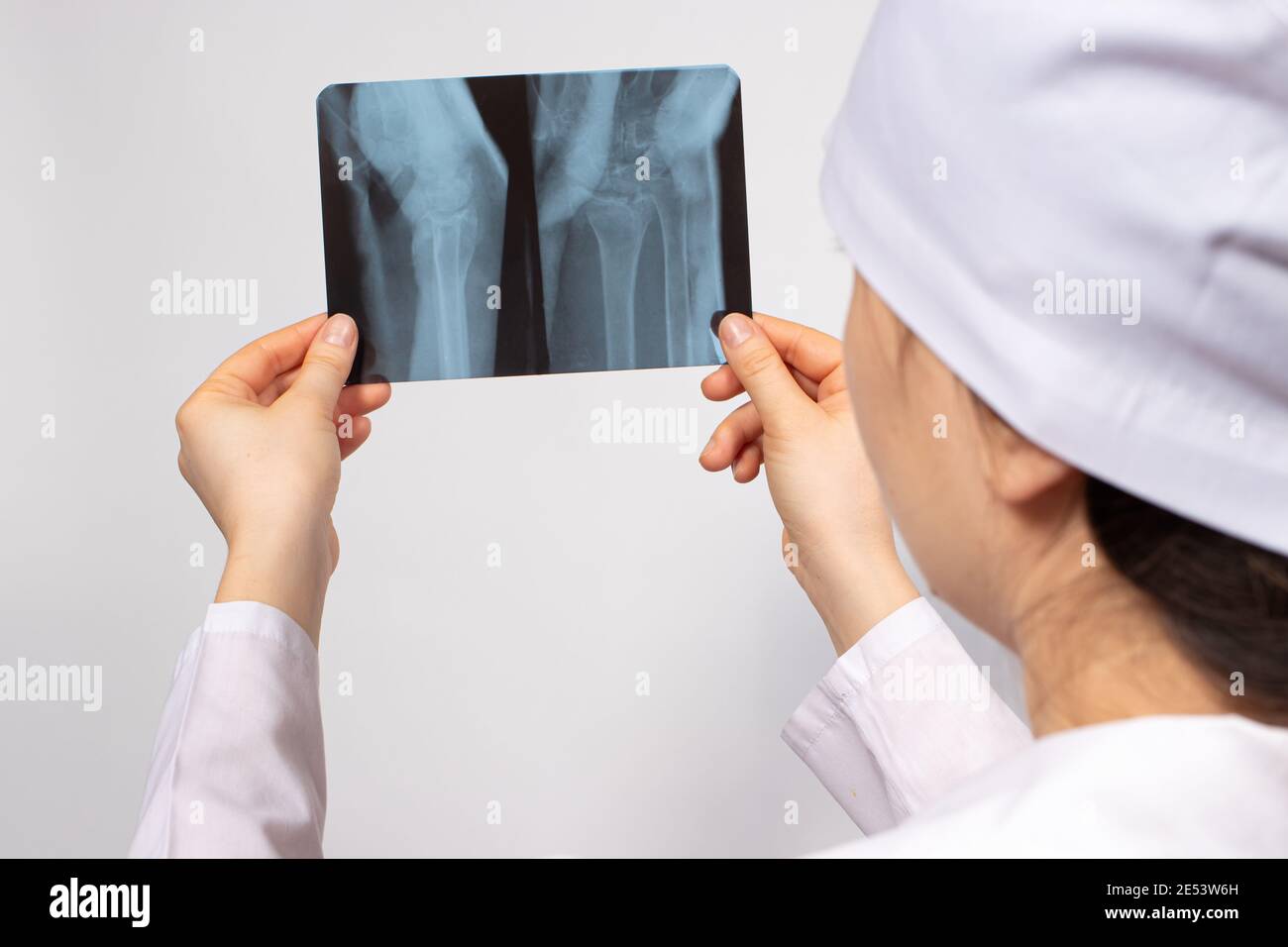 Un medico o un radiologo tiene una radiografia della gamba di una persona - ginocchio, lesione del ginocchio. Diagnosi di fratture o fratture ossee. Foto Stock