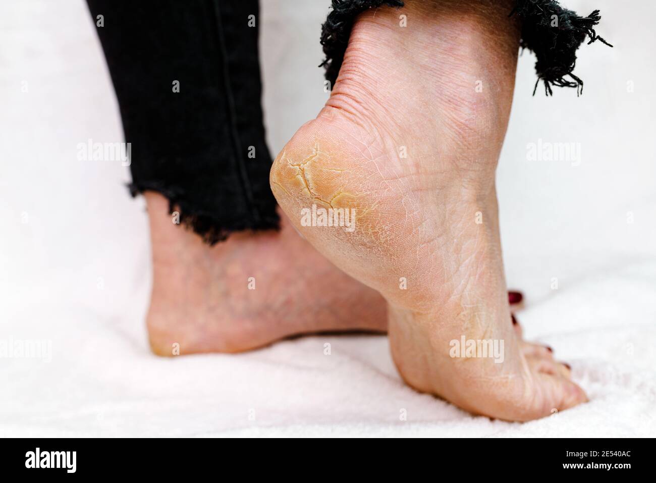 Suole di piedi asciutte e fessurate. Piedi Womans con tacchi asciutti, cracked skin.White sfondo morbido. Foto Stock