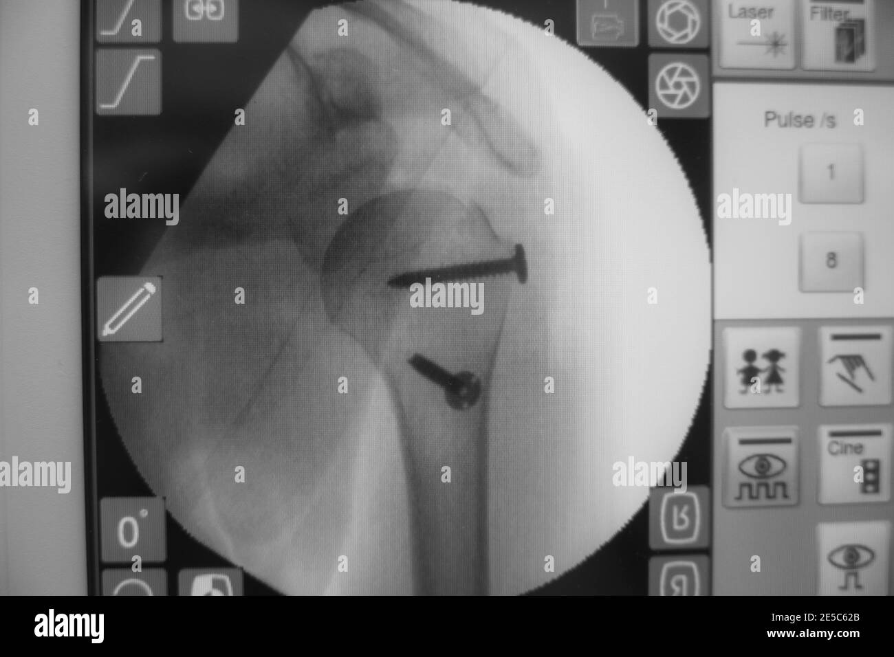 su una macchina a raggi x è possibile vedere una spalla azionata con due viti impiantate Foto Stock