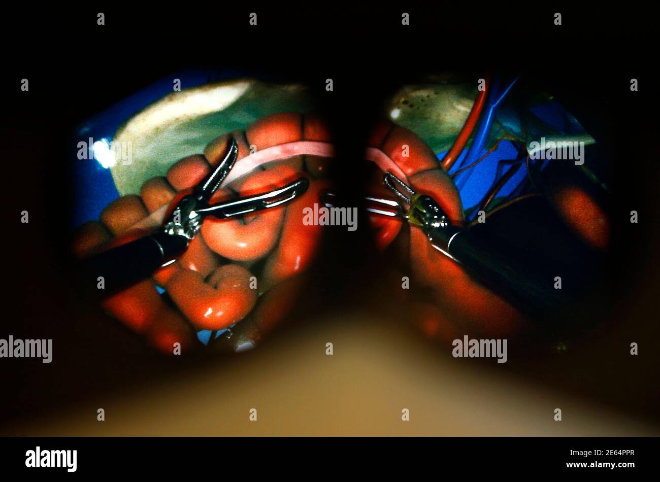 La visione di ciò che un chirurgo vedrebbe è mostrata con un'immagine tridimensionale su un sistema chirurgico da Vinci Xi realizzato da intuitivo chirurgico durante una dimostrazione del robot chirurgico al Palomar Medical Center di Escondido, California 3 dicembre 2014. Il robot di chirurgia minimamente invasiva è un salto tecnologico in avanti nella sostituzione di interventi addominali a grande incisione (chirurgia aperta) ed è ora ottimizzato per interventi chirurgici complessi a più quadranti. REUTERS/Mike Blake (STATI UNITI - Tag: TECNOLOGIA DELLA SCIENZA DELLA SALUTE) Foto Stock