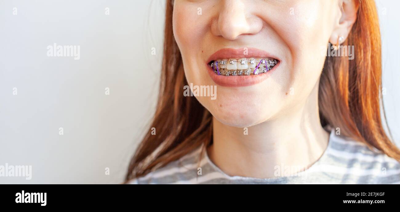 Pila di elastici ortodontici luce uno ottava dimensione 3.2mm Foto stock -  Alamy