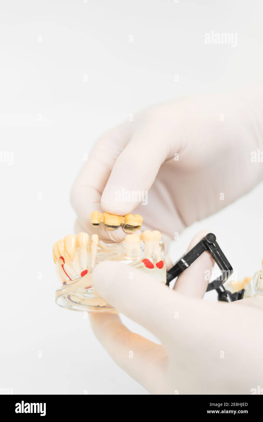 Coltivare un dentista anonimo in guanti protettivi in lattice che mostrano protesi dentarie con impianti cera in clinica moderna Foto Stock