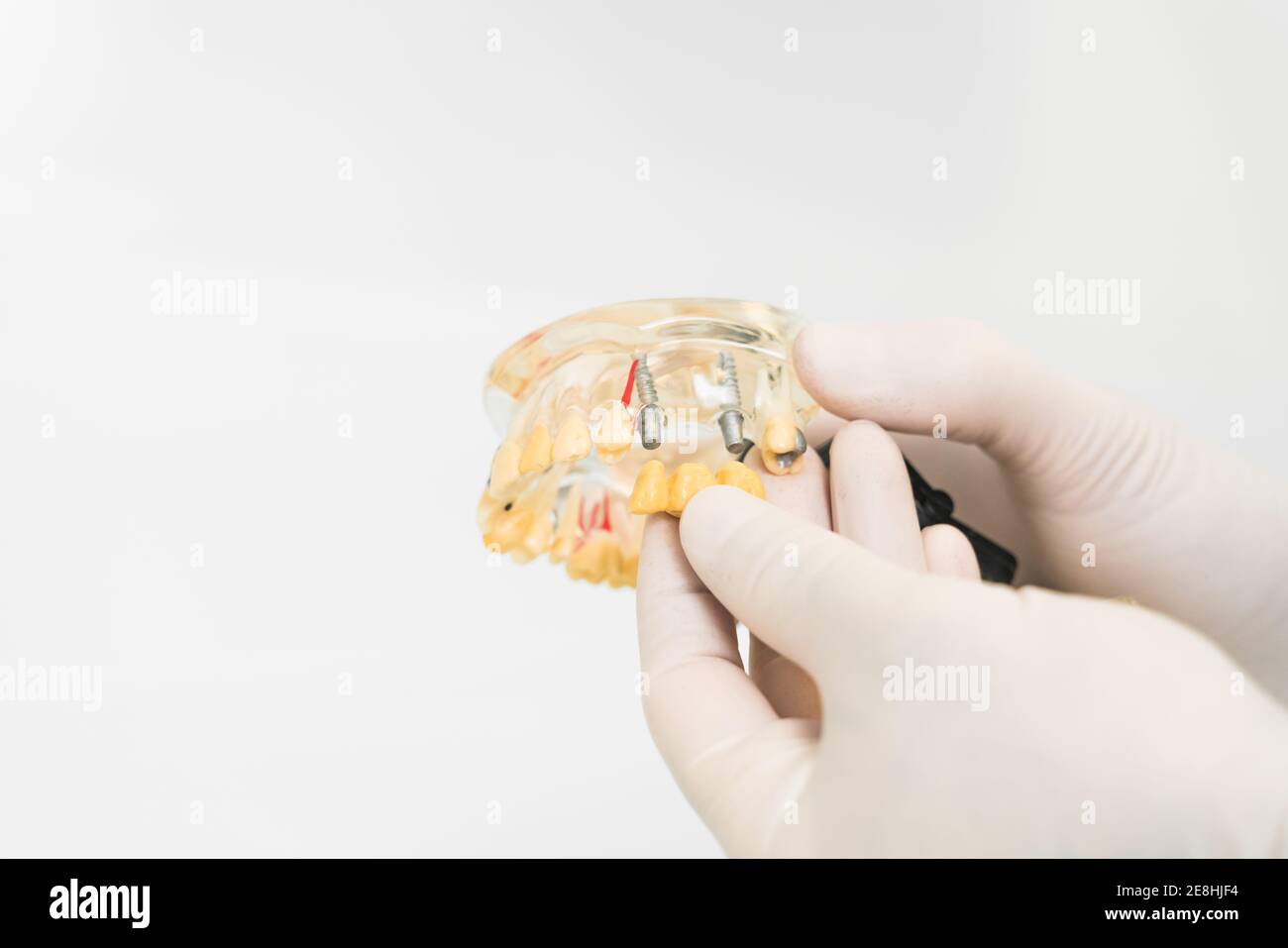 Coltivare un dentista anonimo in guanti protettivi in lattice che mostrano protesi dentarie con impianti cera in clinica moderna Foto Stock