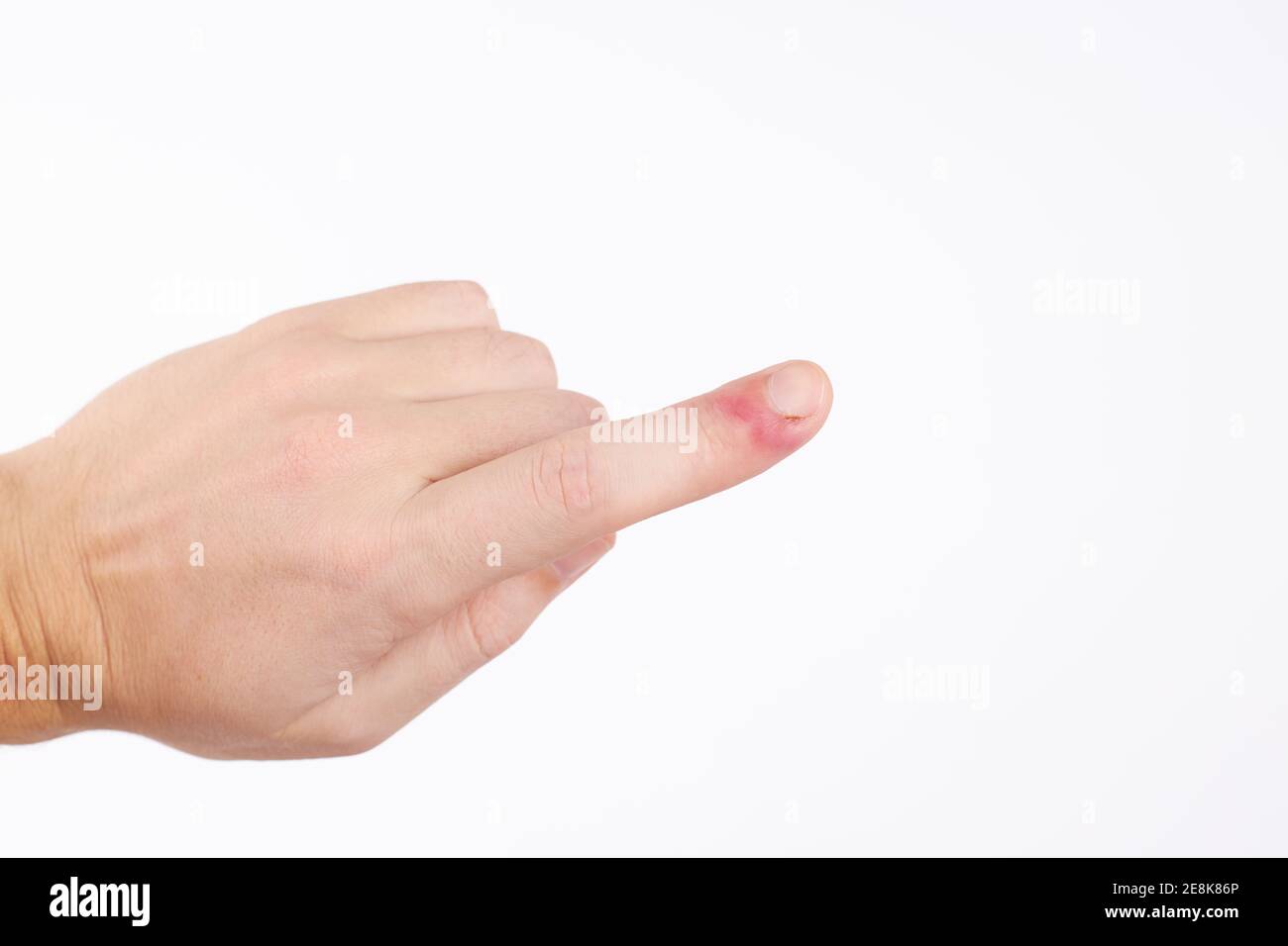 persona con infezione delle dita. dolore alle unghie. isolato su sfondo bianco. copia spazio Foto Stock