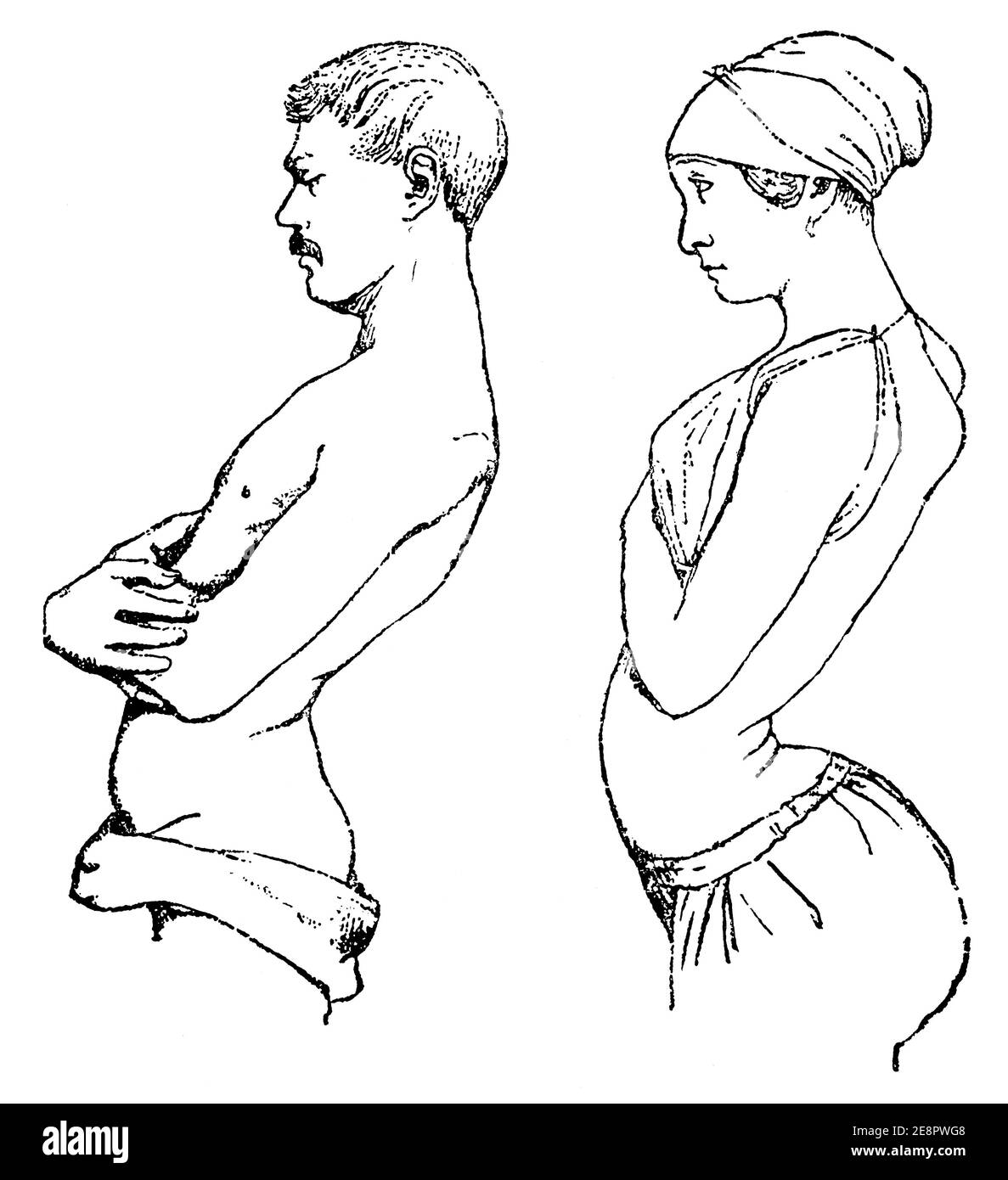 Spina dorsale molto storta rotta a causa della scarsa postura. Illustrazione del 19 ° secolo. Germania. Sfondo bianco. Foto Stock