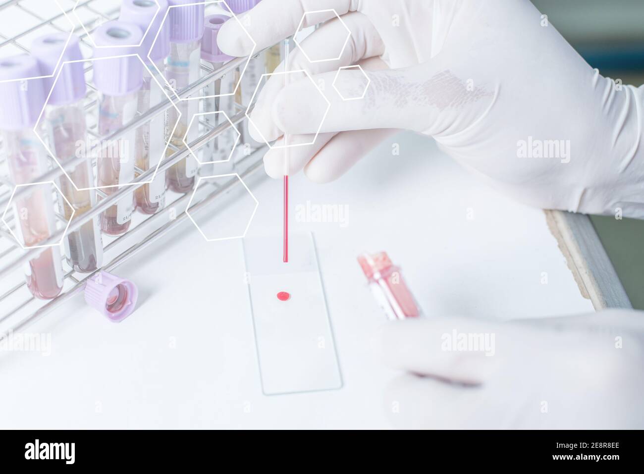 Campionamento del sangue con ago per analisi in laboratorio Foto Stock