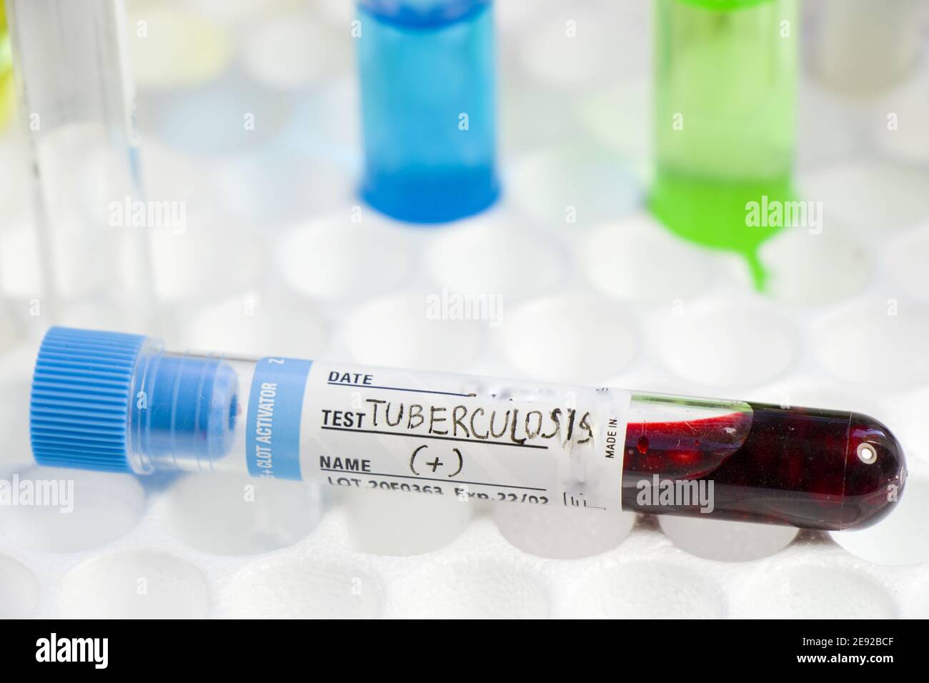 Prelievo di campioni di sangue positivo per tubercolosi sulla provetta in laboratorio Foto Stock