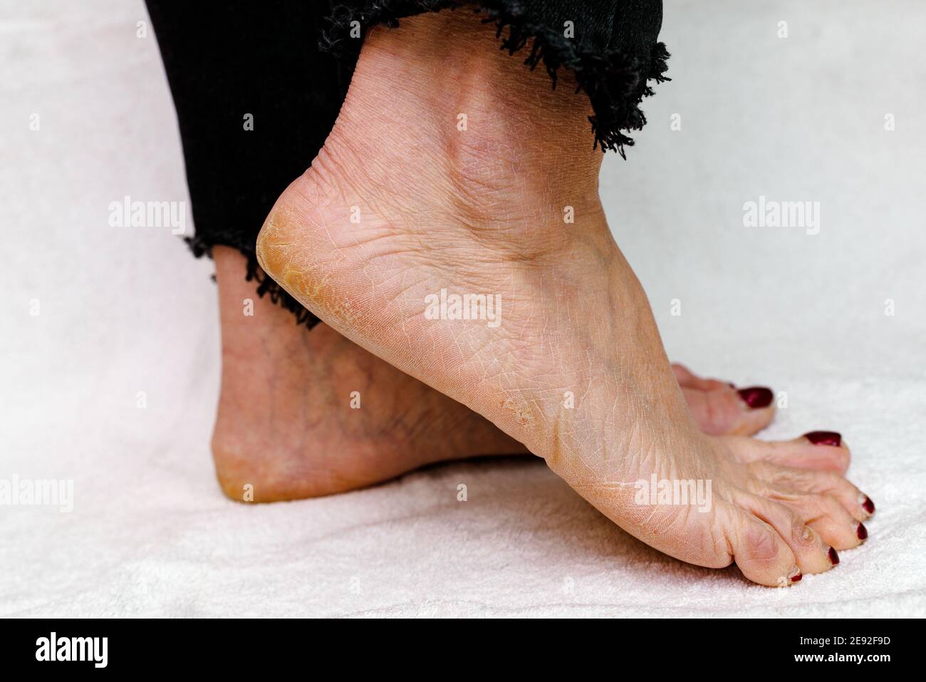 Suole di piedi asciutte e fessurate. Piedi Womans con tacchi asciutti, cracked skin.White sfondo morbido. Foto Stock