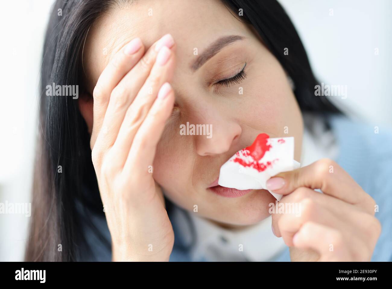 Donna con mal di testa che tiene un tovagliolo sanguinante vicino al naso Foto Stock