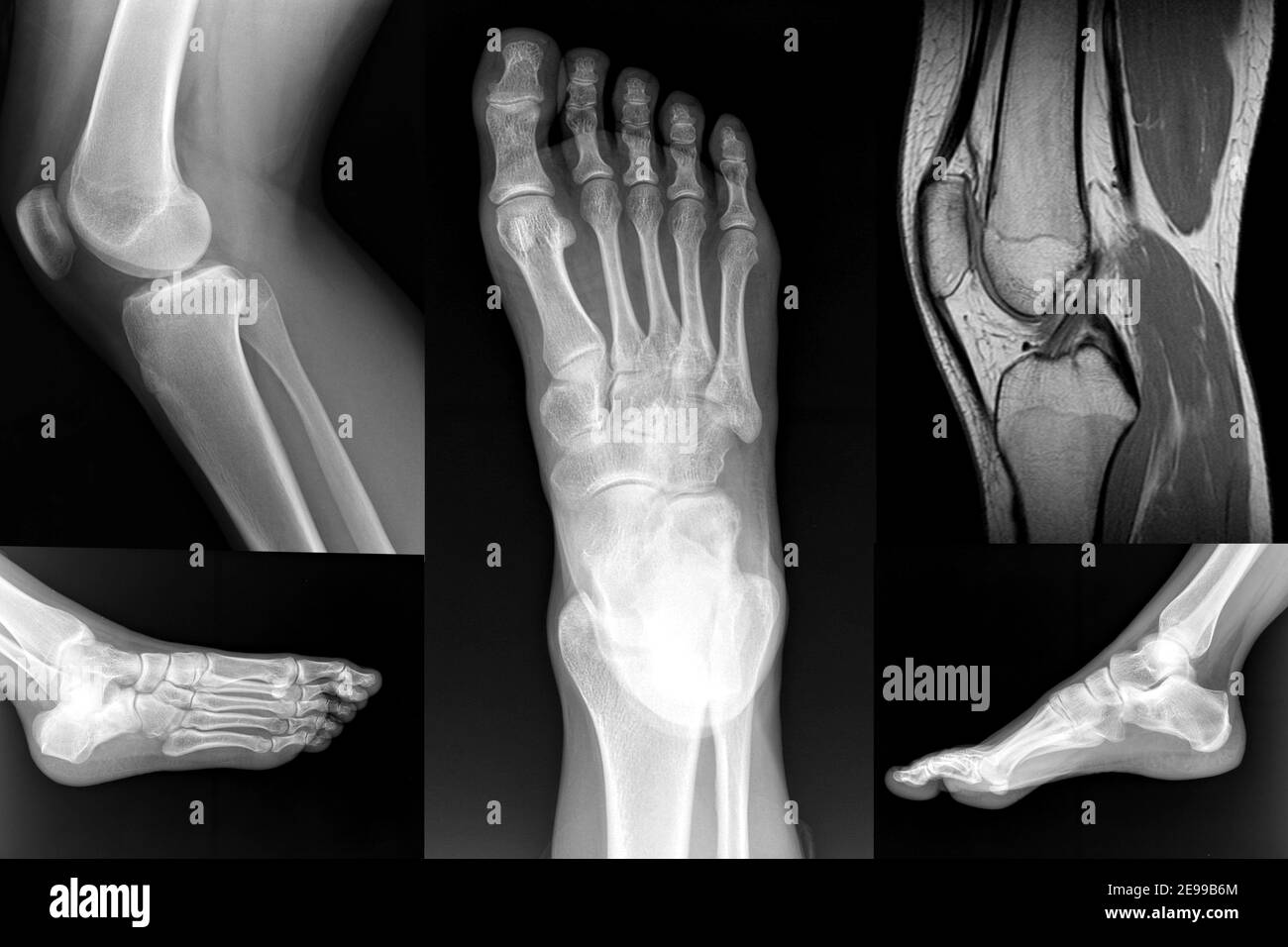 Collage ortopedico di piede e ginocchio XRay Foto Stock