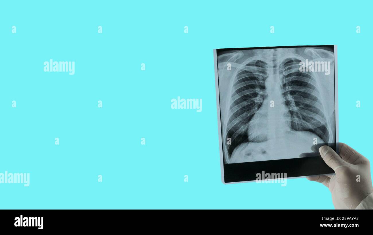 Raggi X dei polmoni con spazio di copia per il testo per l'inserimento di  oggetti,