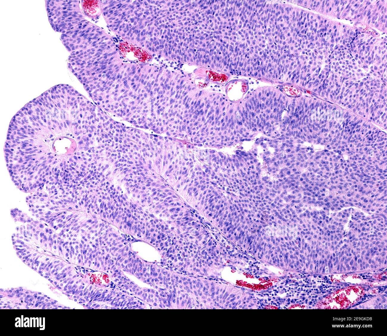 Papiloma uroteliale della vescica urinaria. Neoplasia benigna formata da papille con nucleo fibrovascolare ricoperto da urotelio. Foto Stock