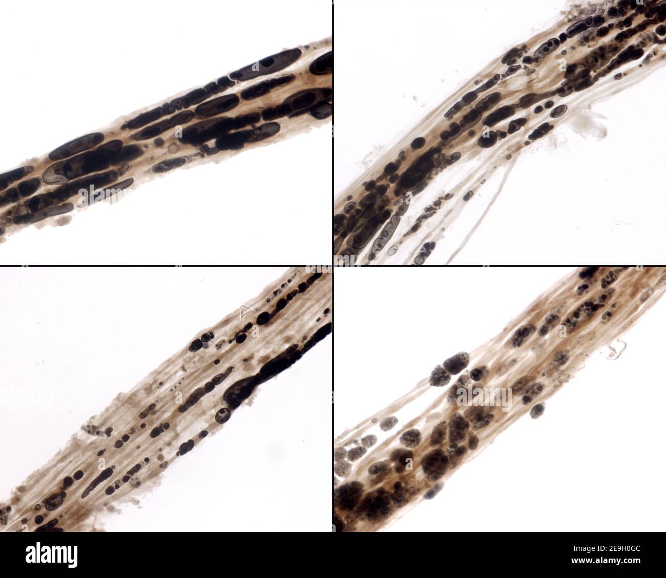 Da sinistra a destra e dall'alto verso il basso, diverse fasi del processo di degenerazione walleriana delle fibre nervose mielinate danneggiate Foto Stock