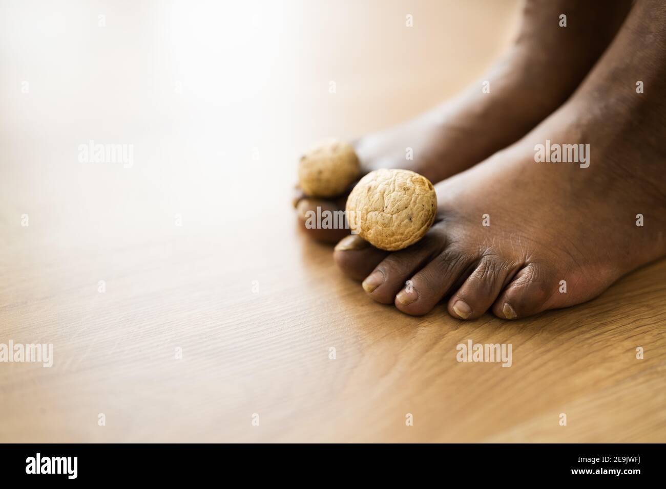 Fungo funghi tra Toenail. Piedi e funghi puzzolenti Foto Stock