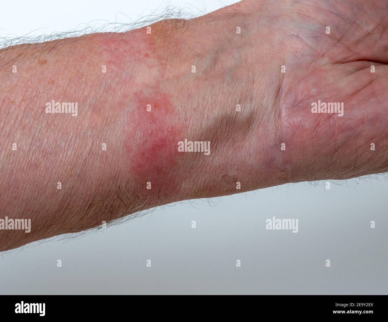 Primo piano di dermatite da contatto o allergia cutanea dovuta a. indossare  un cinturino da orologio in pelle Foto stock - Alamy