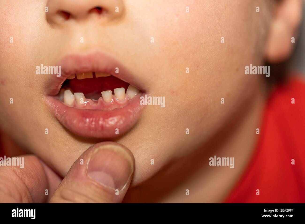 Vista ravvicinata della bocca del bambino con il primo dente perduto. Foto Stock