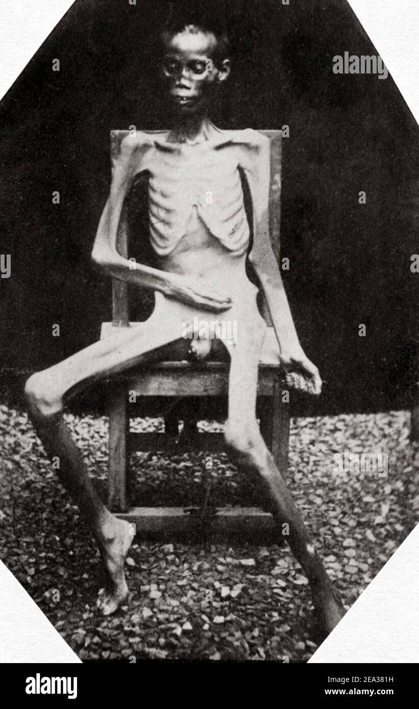 Foto del tardo 19 ° secolo - un dipendente di oppio, tossicodipendente, poco prima della morte, francese Indo-Cina, Vietnam, circa 1880 Foto Stock