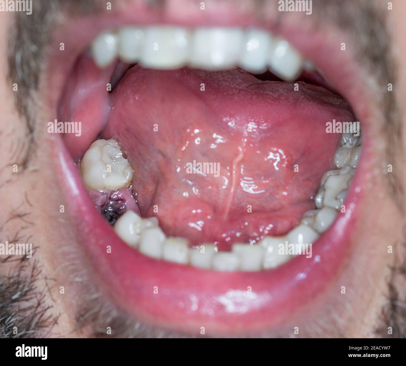 Primo piano di un traferro dentario in bocca maschio per un impianto dentale con ferita aperta fresca e sangue, Germania Foto Stock