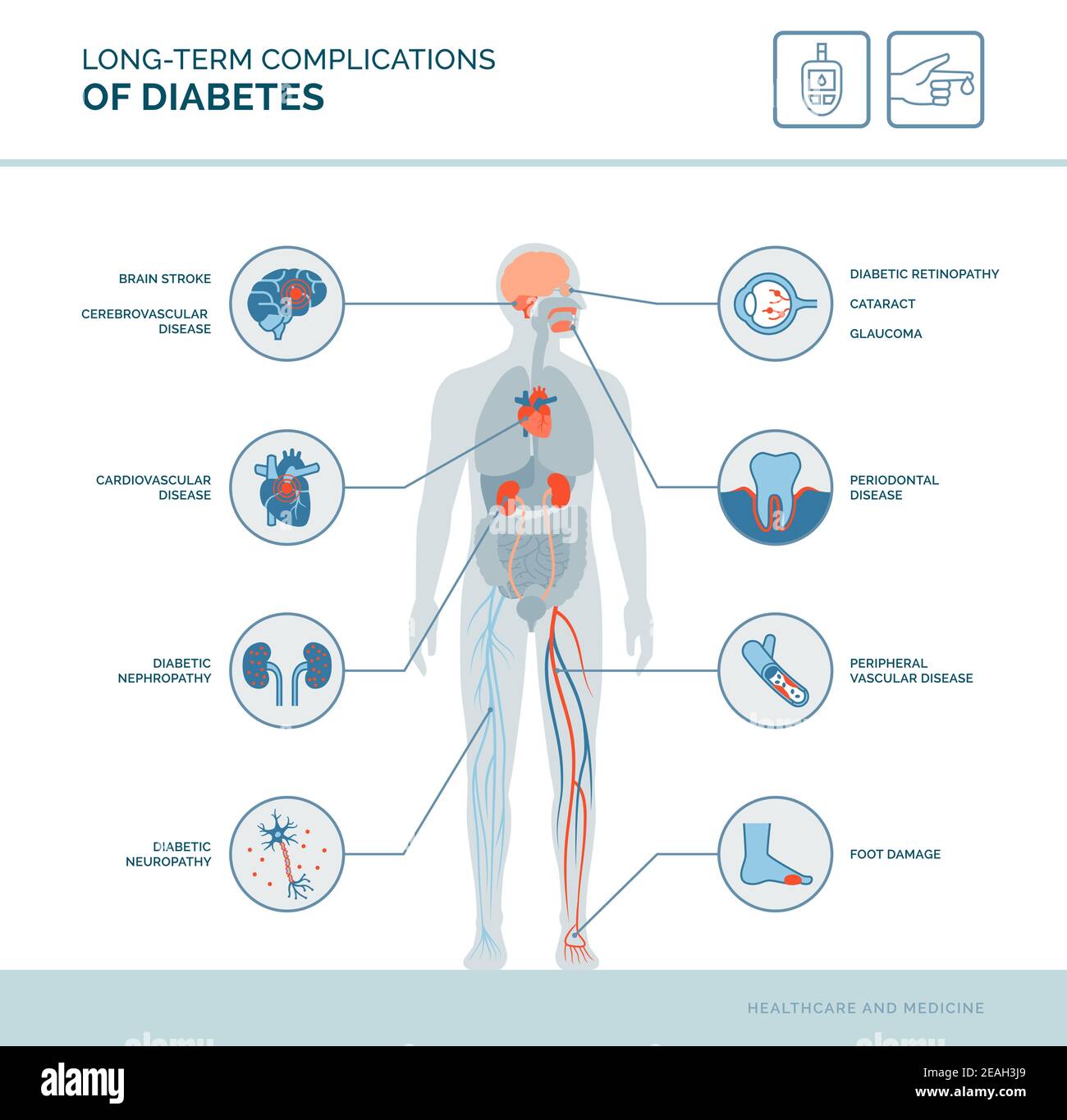 Complicazioni a lungo termine del diabete infografica medica: Diabete effetti sul corpo Illustrazione Vettoriale