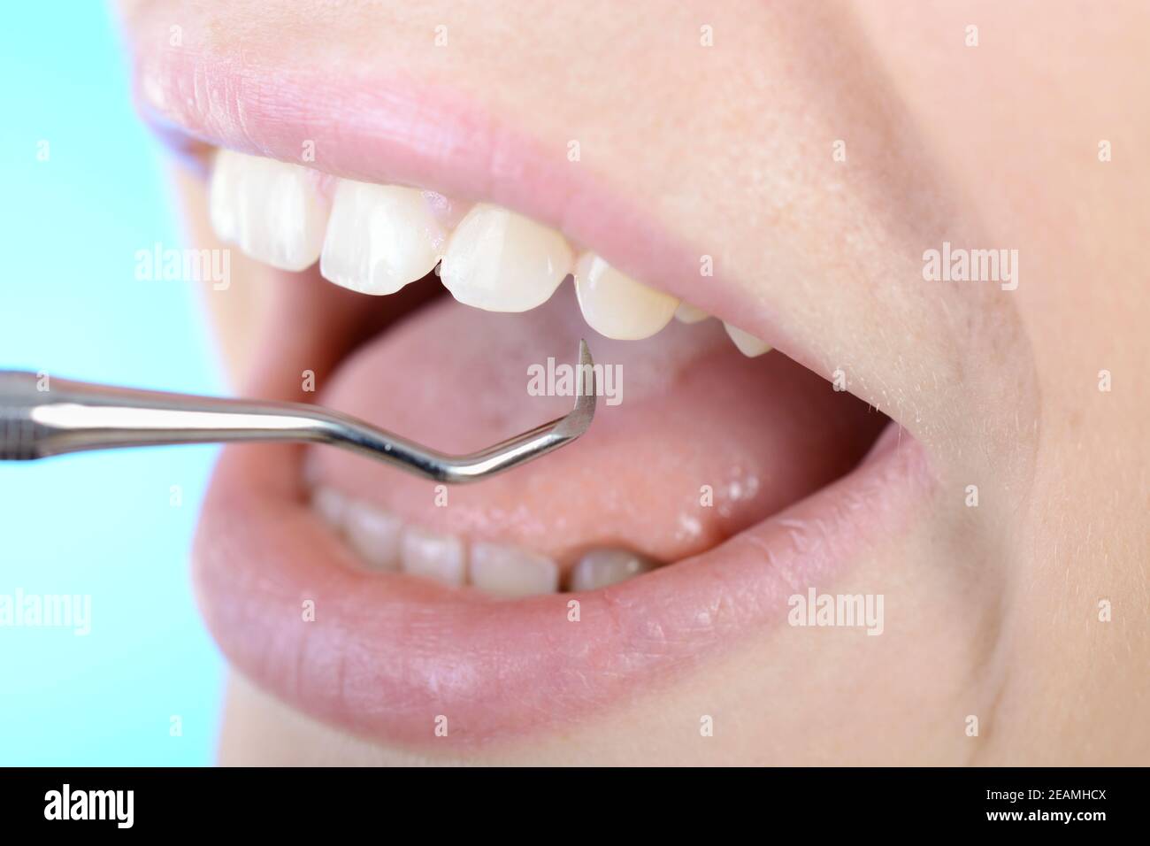 Zahnbehandlung durch Zahnarzt mit Haken Foto Stock