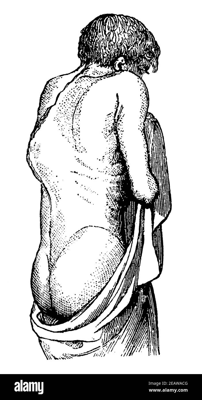 Manifestazioni esterne di tubercolosi delle ossa della colonna vertebrale. Illustrazione del 19 ° secolo. Germania. Sfondo bianco. Foto Stock