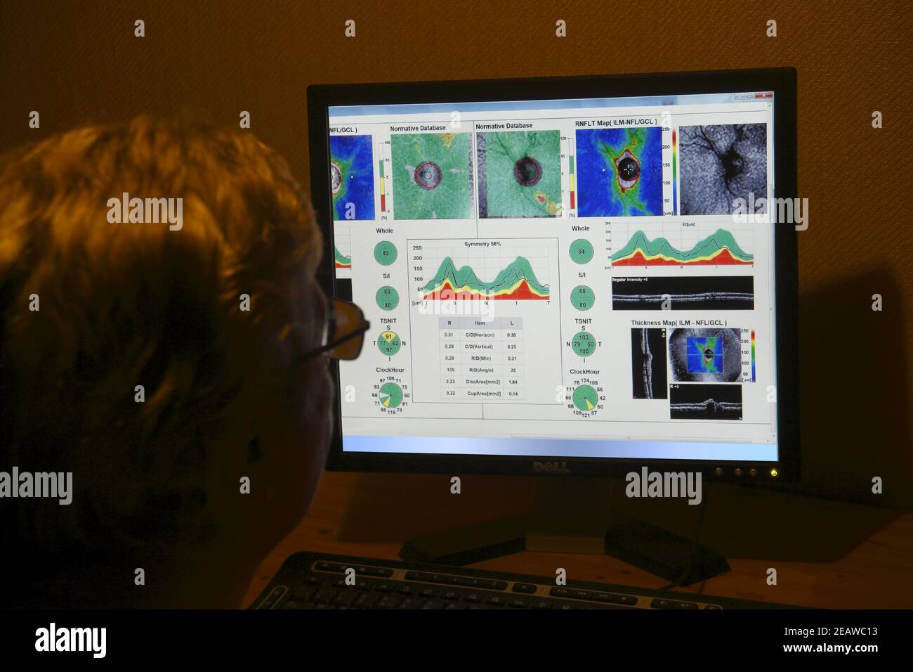Specialista oculista femminile, (posato dal modello), che guarda le scansioni di un test oculistico sullo schermo di un computer in una stanza buia Foto Stock