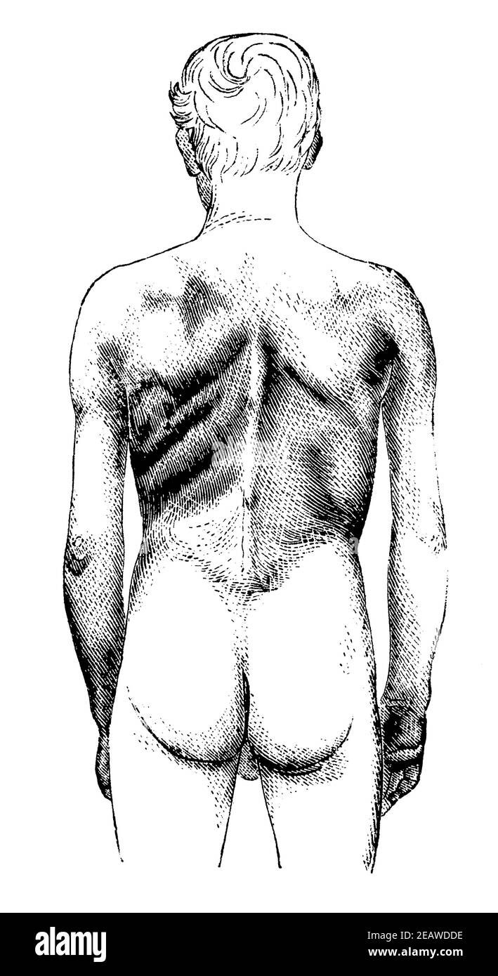 Paralisi muscolare del corpo superiore di un lavoratore a causa di avvelenamento cronico del piombo. Vista posteriore. Illustrazione del 19 ° secolo. Germania. Sfondo bianco. Foto Stock