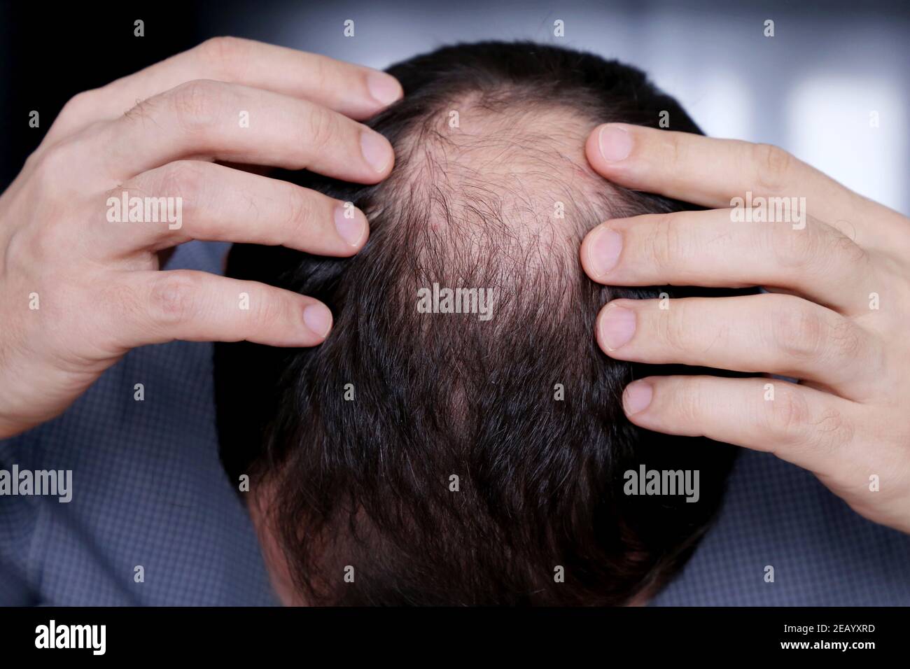 Calvizie, l'uomo preoccupato per la perdita dei capelli. Testa maschio con calvo Foto Stock