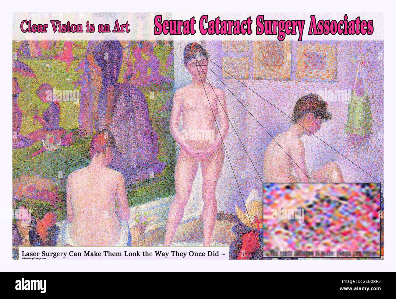 Seurat Cataract Chirurgia associati 2000 Foto Stock