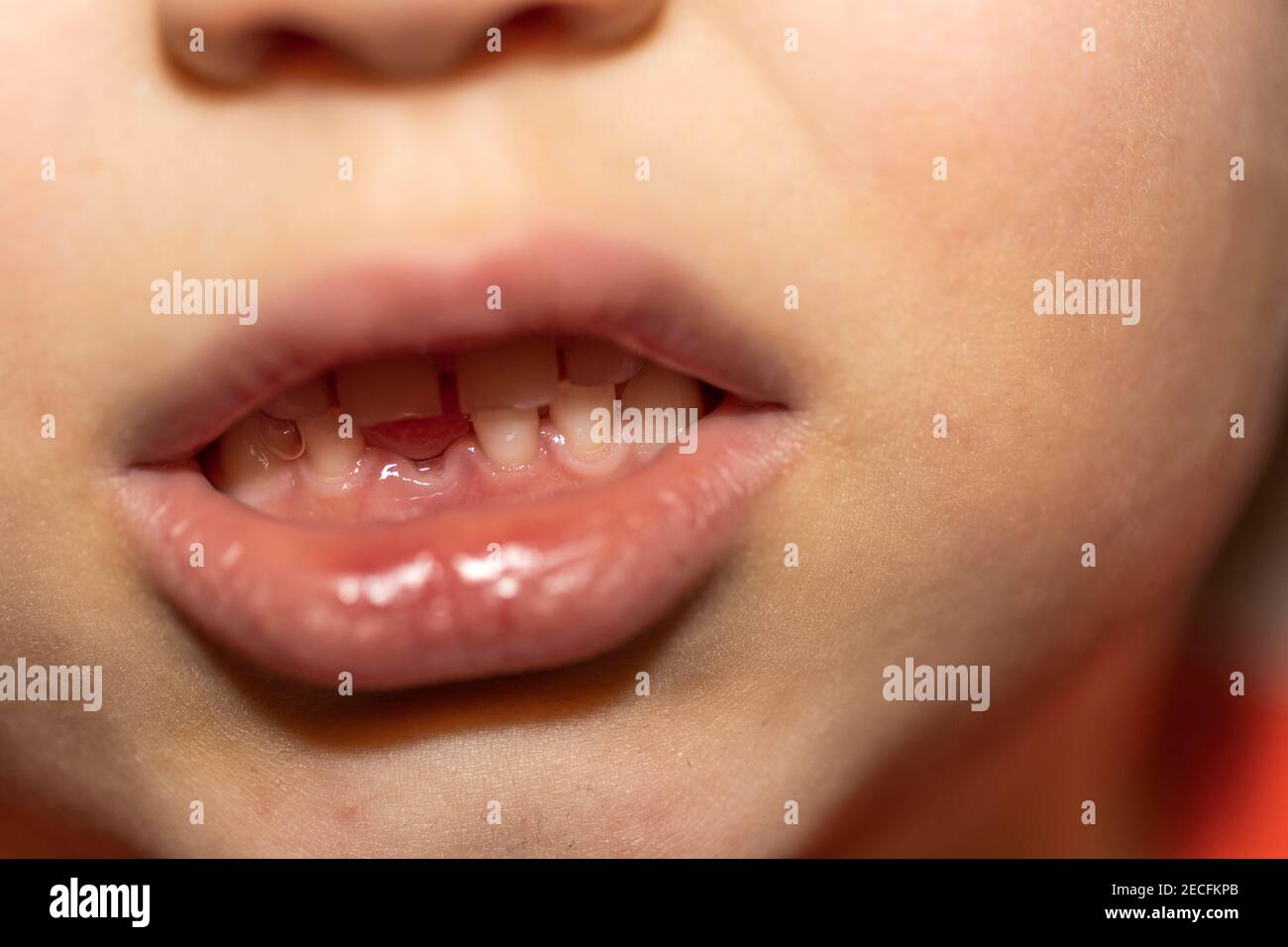 Vista ravvicinata della bocca del bambino con il primo dente perduto. Foto Stock