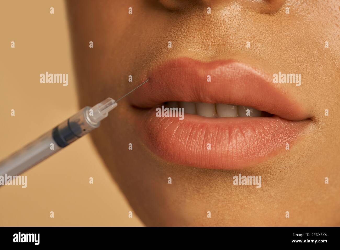 Primo piano di iniezione cosmetica alle labbra di giovane donna isolato su sfondo beige. Bellezza, concetto di cosmetologia. Shot orizzontale Foto Stock