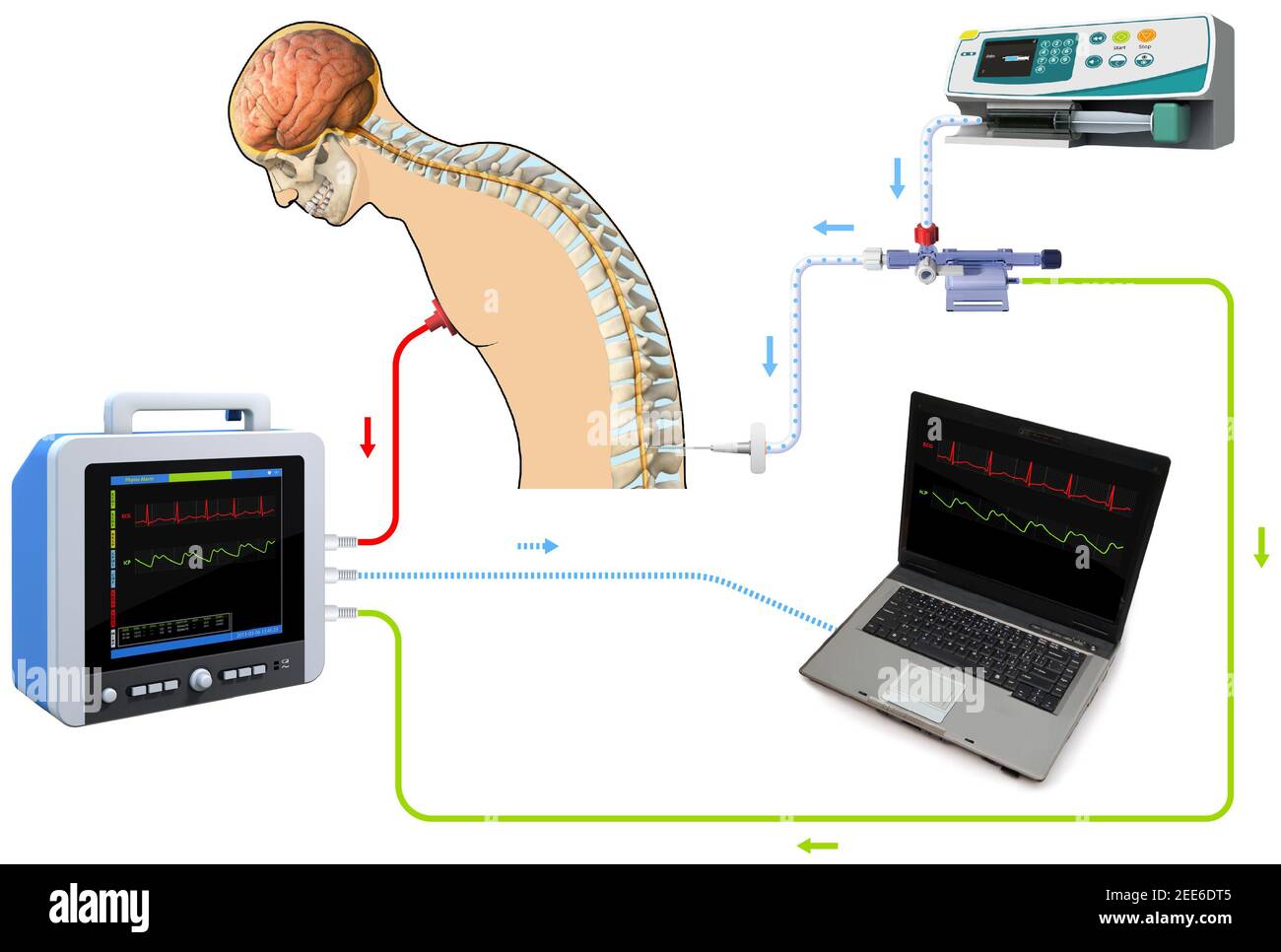 Puntura lombare diagnostica canale spinale prelievo campione paziente trattamento tumore MS, rendering 3D e grafica 2d Foto Stock