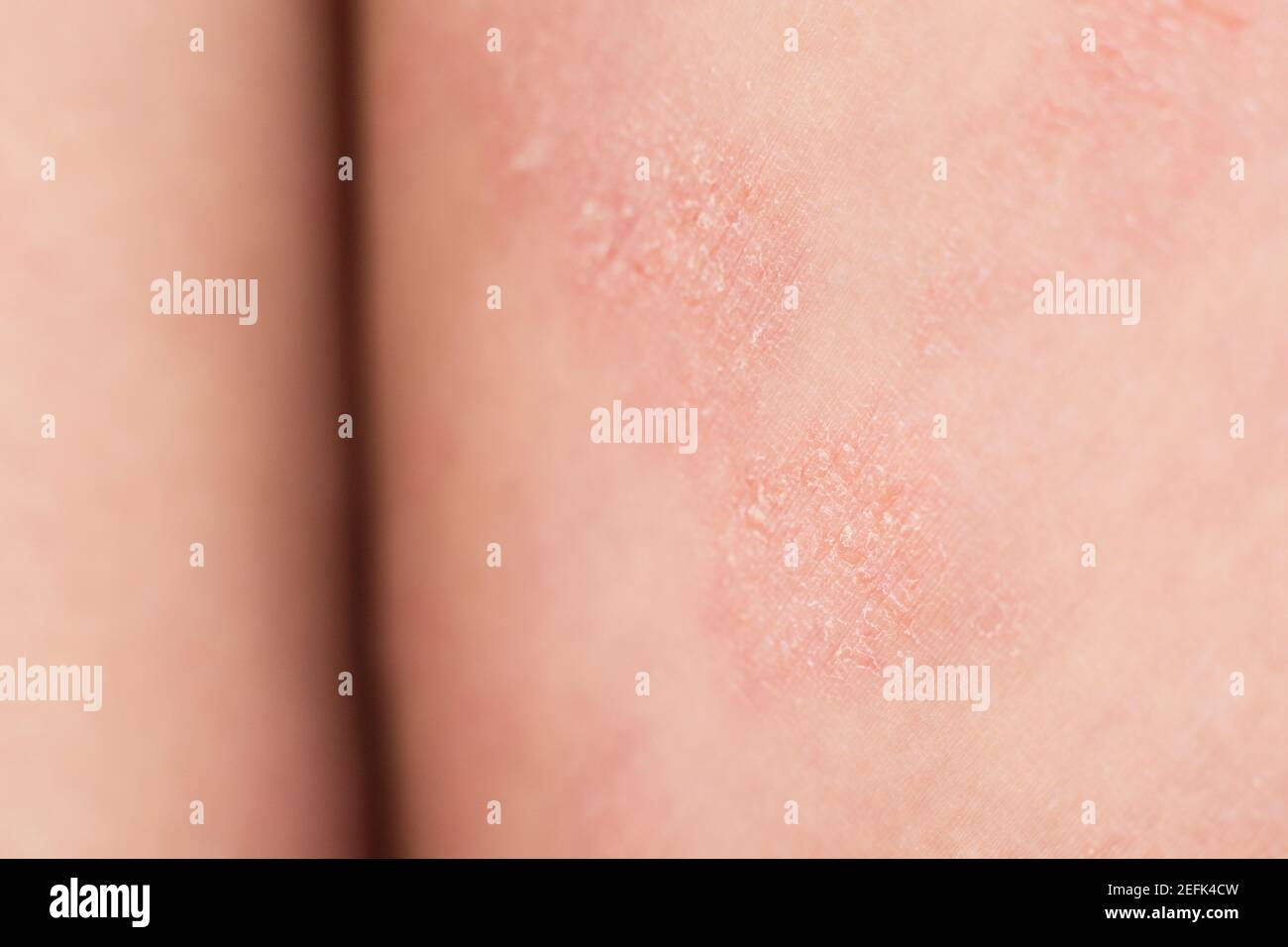 Primo piano l'eczema atopico grave sulle gambe dietro le ginocchia di un bambino è una malattia dermatologica della pelle. Eruzione cutanea grande, rossa, infiammata e scalosa sul Foto Stock