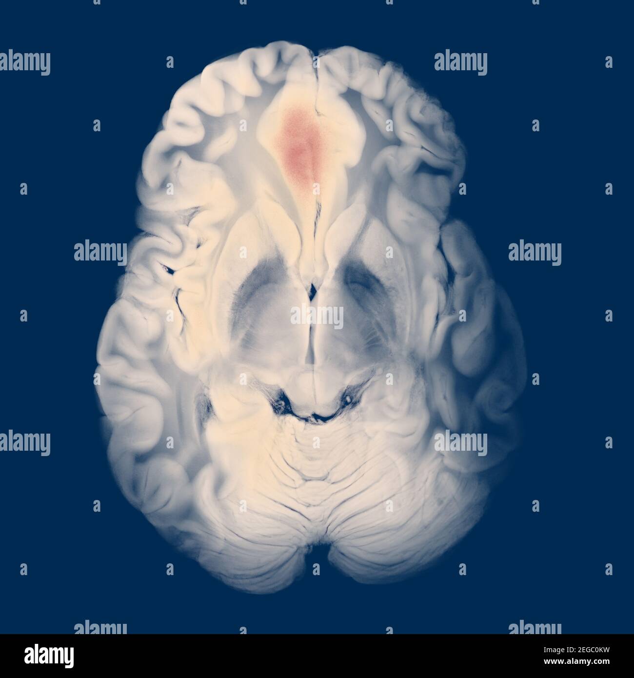 Sezione assiale del cervello con una parte frontale destra rigonfia Ematoma lobo Foto Stock