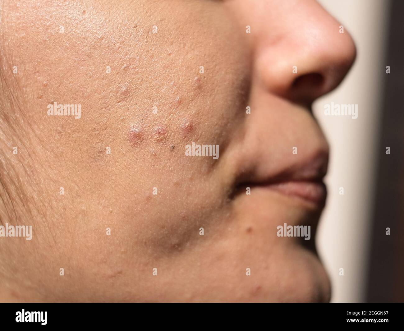 Giovane donna con acne pelle faccia vicino vista, ormone dermatologico malattia Foto Stock