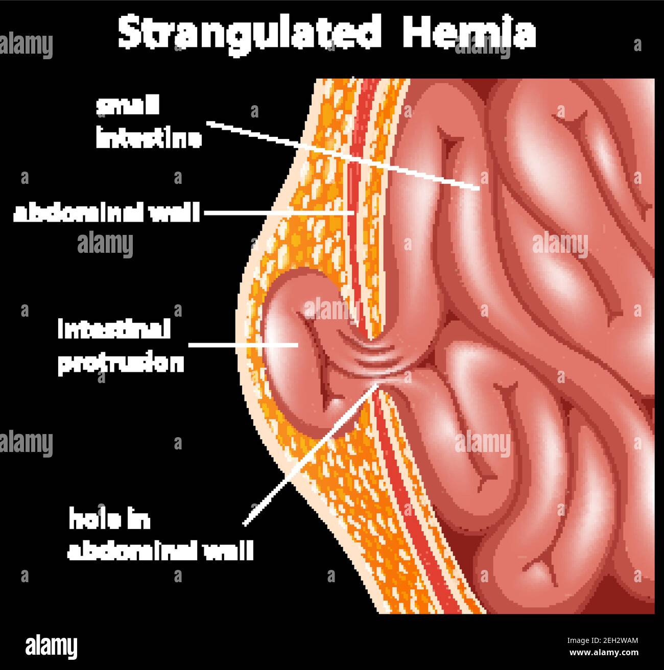 Illustrazione del diagramma anatomico dell'ernia strangolata Illustrazione Vettoriale