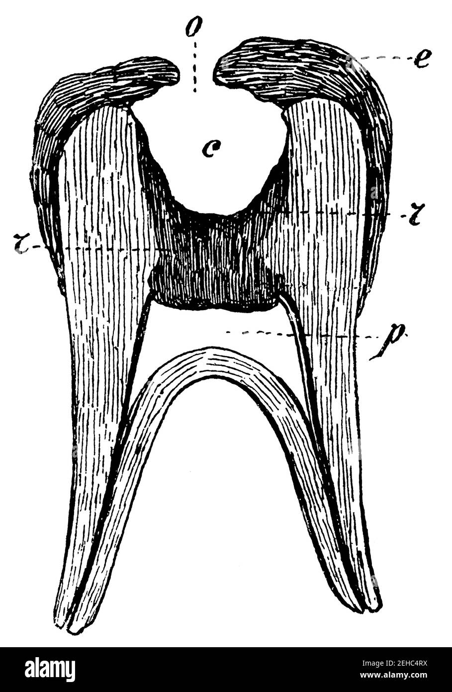Decadimento dei denti. Denti che diventano cavi. Prima fase. Illustrazione del 19 ° secolo. Germania. Sfondo bianco. Foto Stock