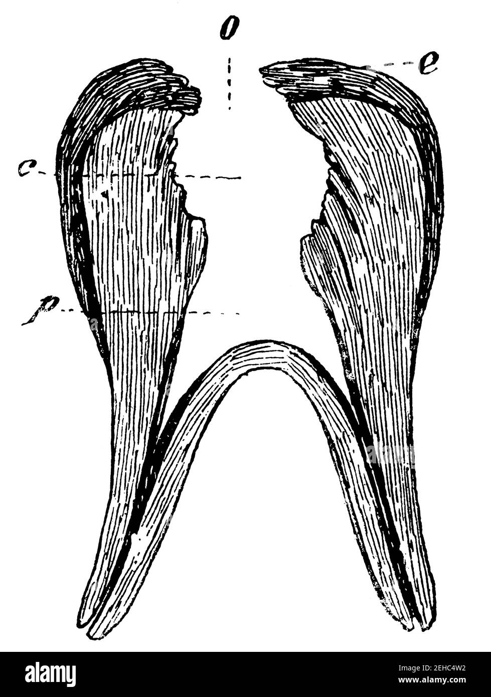 Grave forma di decadimento dei denti. Denti che diventano cavi. Illustrazione del 19 ° secolo. Germania. Sfondo bianco. Foto Stock