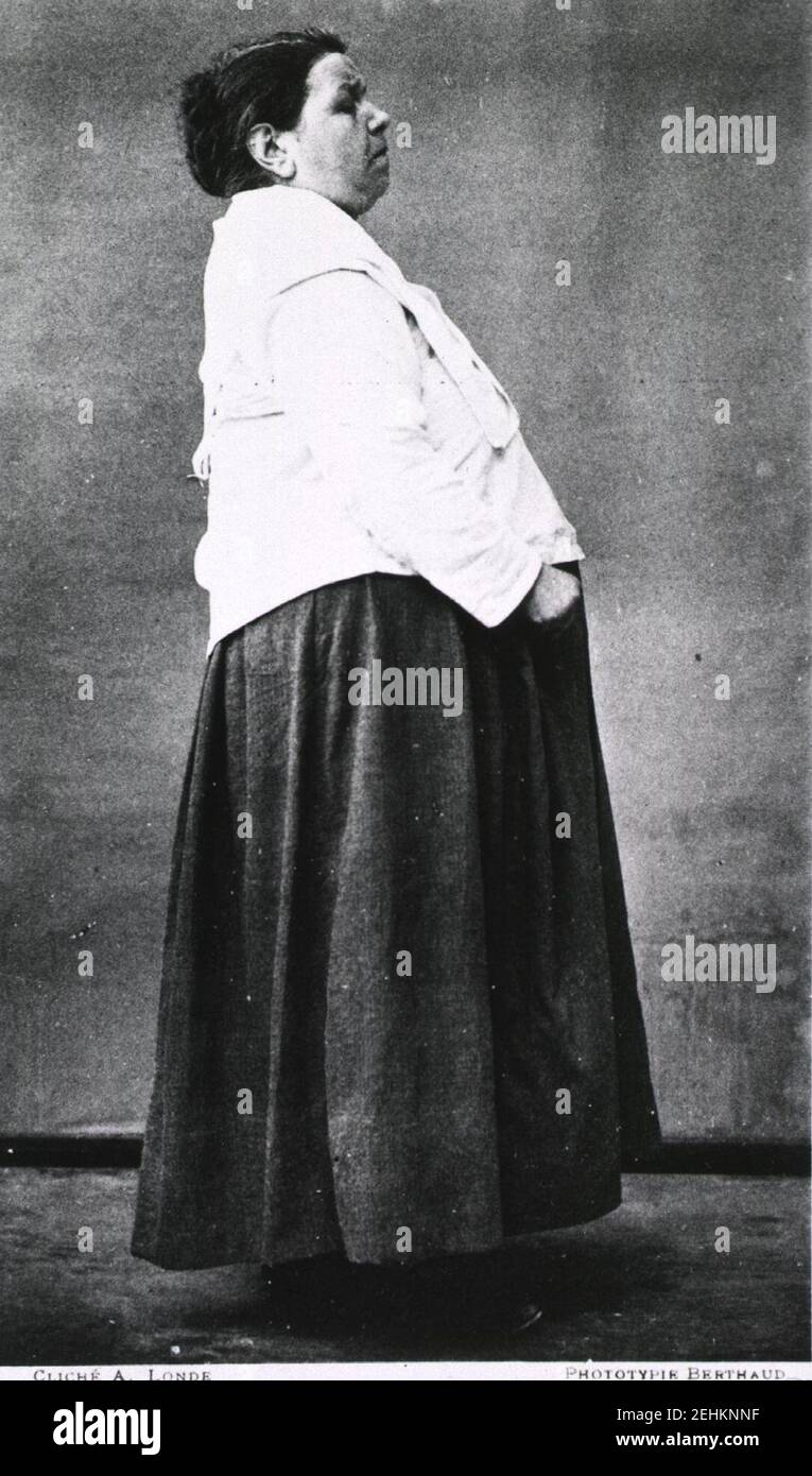 Paralisi agitans-Donna con morbo di Parkinson-Nouvelle Iconographie de la Sampetriere-vol 2-pl29. Foto Stock