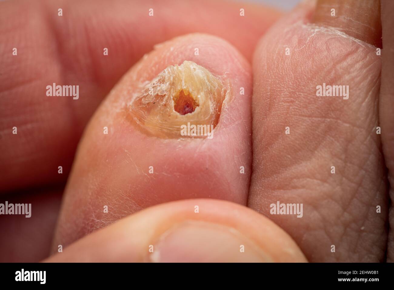 Fungo buco closeup nel piede unghia Foto Stock