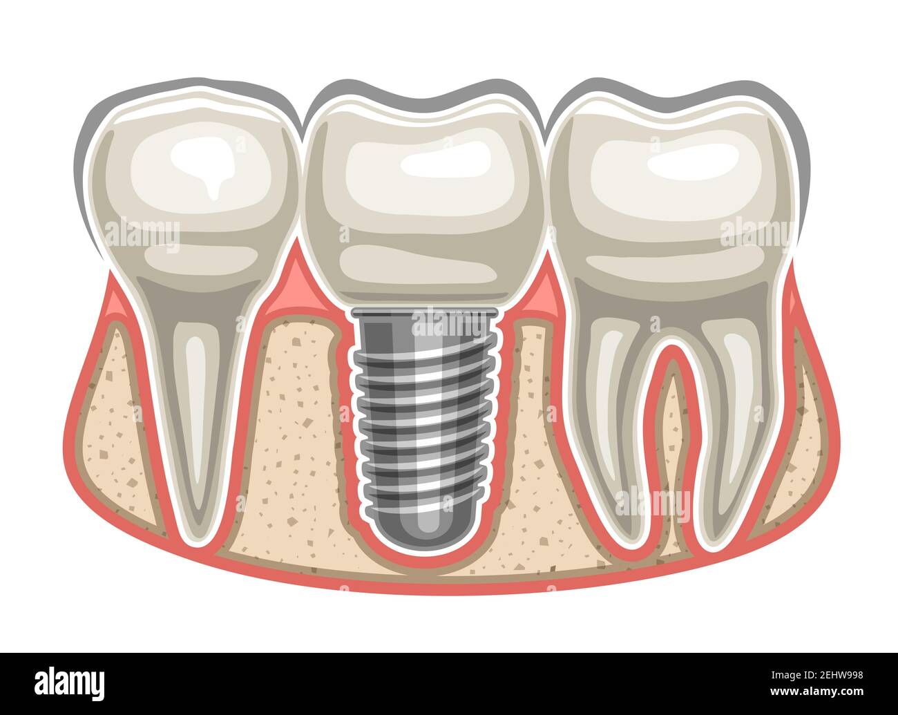 Illustrazione vettoriale dell'impianto dentale, 3 denti umani in fila e dente artificiale in ceramica con vite nella mascella ossea, segnaletica decorativa per professionisti Illustrazione Vettoriale