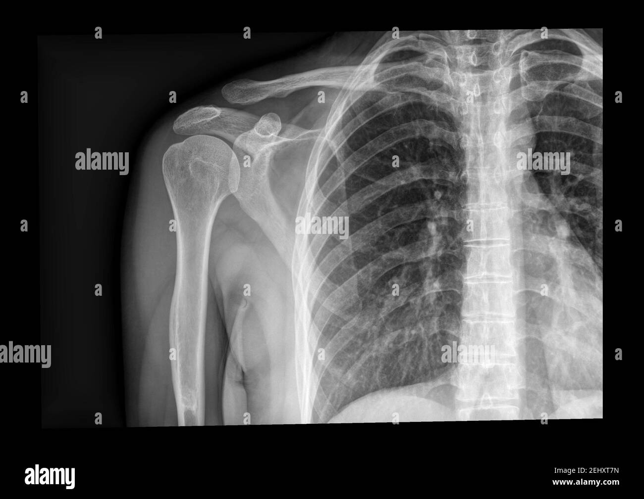 Radiografia della spalla che mostra la rottura dell'acromioclavolo, lesioni sportive Foto Stock