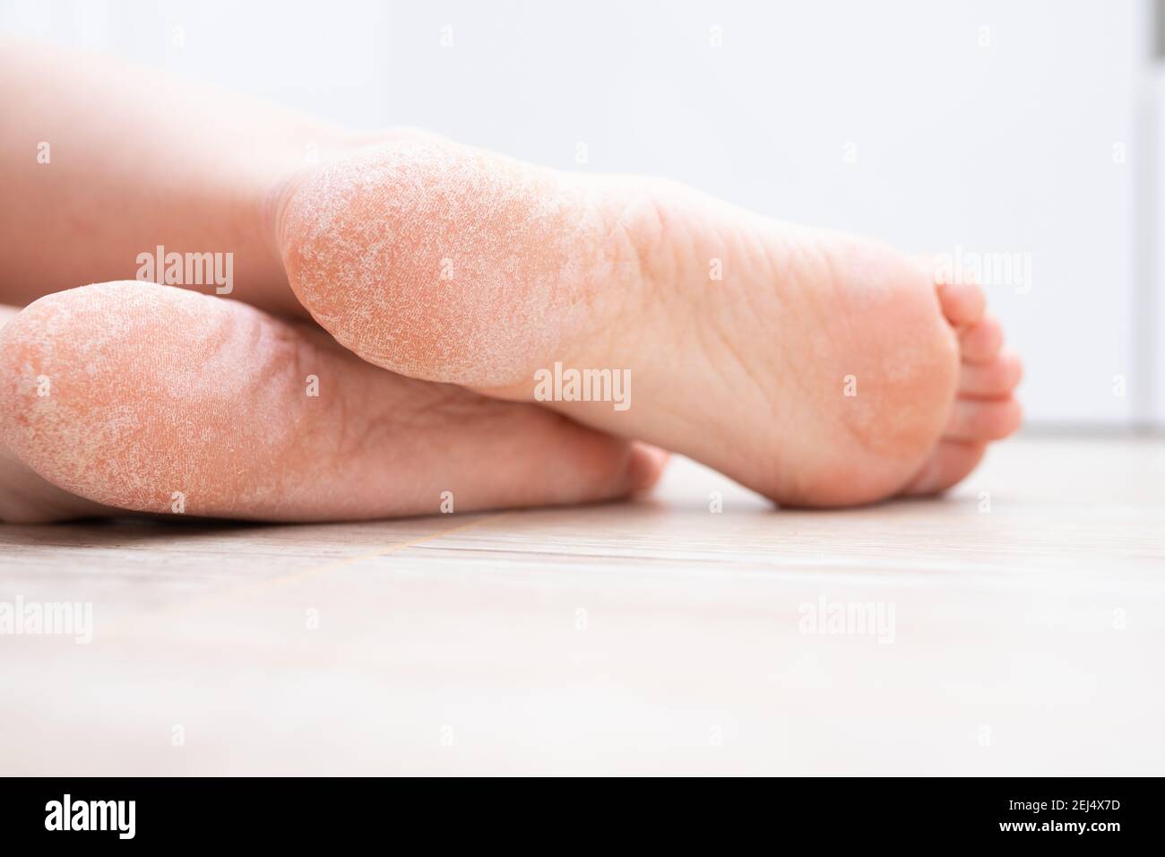 La pelle asciutta sui piedi è incrinata. Concetto di trattamento con creme idratanti ed esfoliazione per la guarigione di ferite e dolore durante la camminata. Disidratato Foto Stock