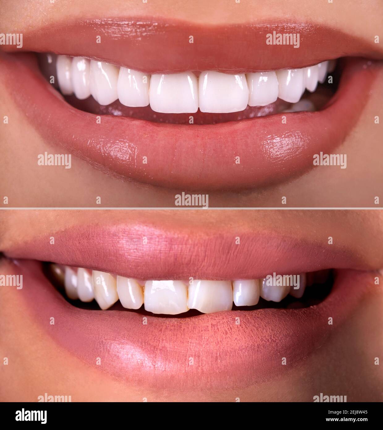 Armonizzazione della linea del sorriso: corona su impianto e ricostruzione  su dente naturale