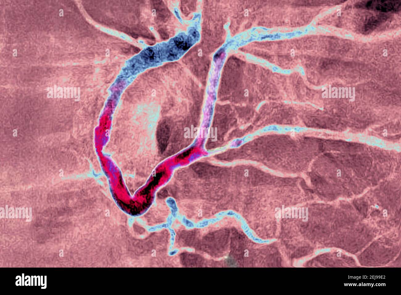 Infarto miocardico con un trombo significativo Foto Stock